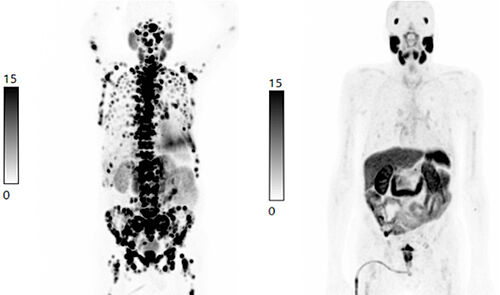 PSMA radioligand therapy