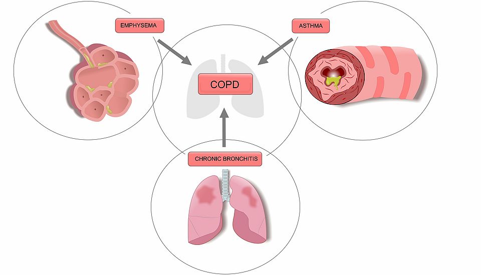 [Translate to English:] COPD