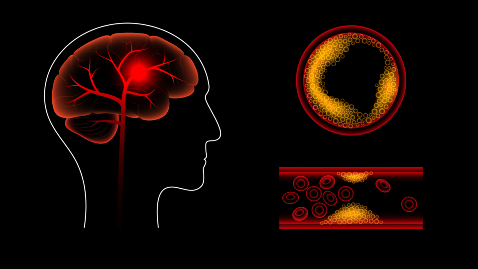 ischaemic brain stroke