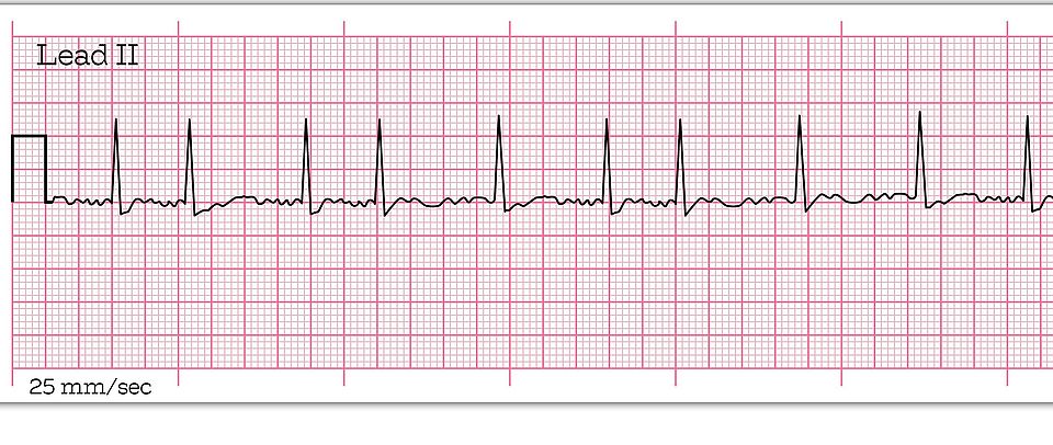 ECG Atrial Fibrillation - 8 Second ECG Paper - Electrocardiography Vector Medical Illustration Symbolbild AF