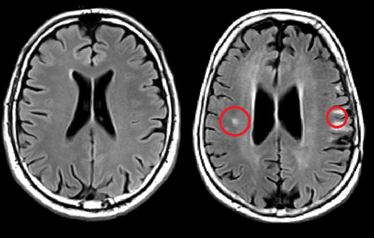 MRI brain lesions